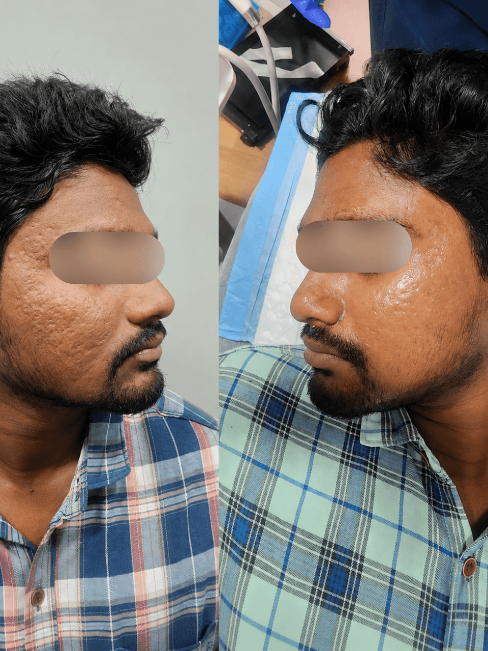 Before and after acne scar side profile treatment result