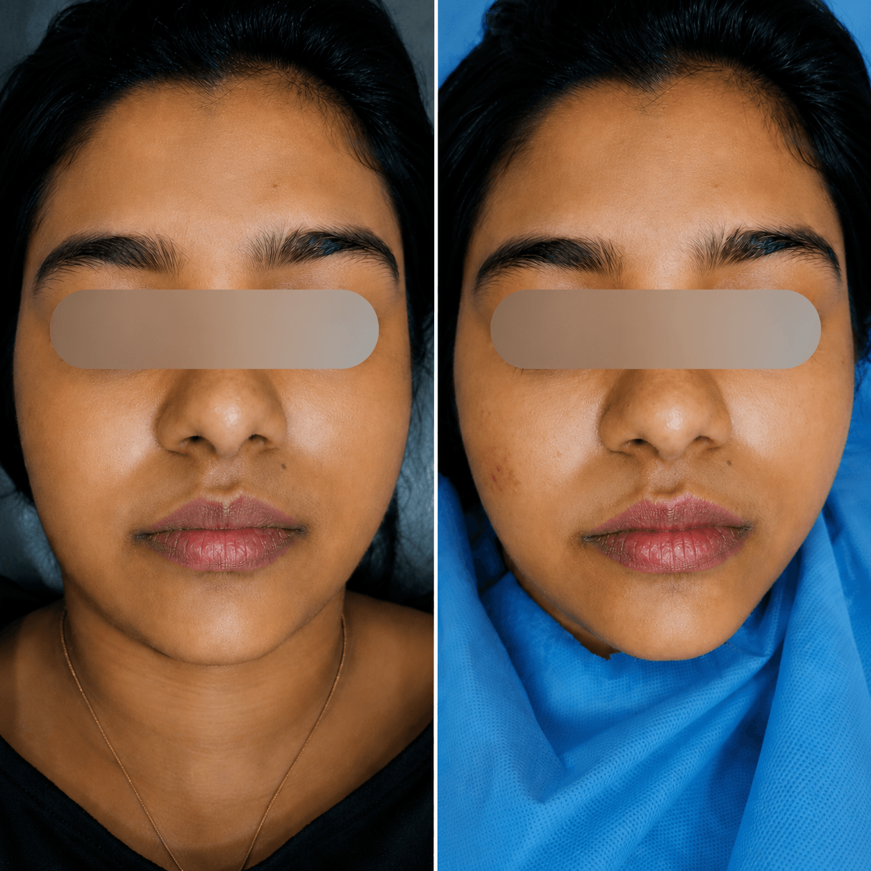 Before and after face skin brightening treatment result