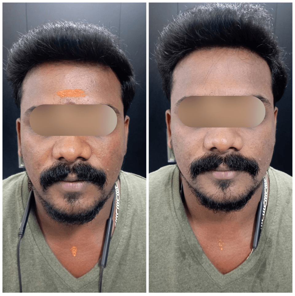 Before and after pigmentation treatment result