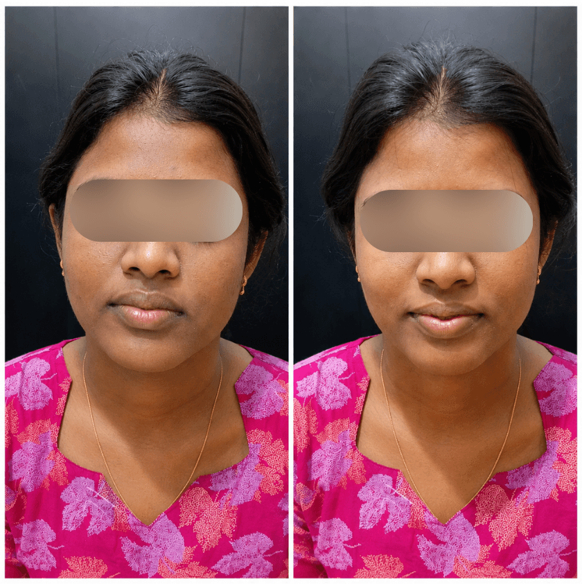Before and after skin brightening treatment result